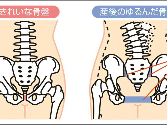 産後の骨盤矯正は大事です！