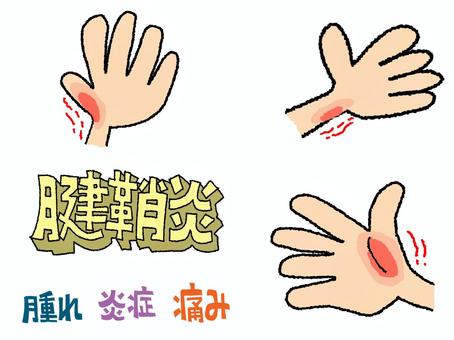 睡眠不足や疲労が重なると、筋肉が回復しにくくなり、腱鞘炎が悪化しやすくなります。