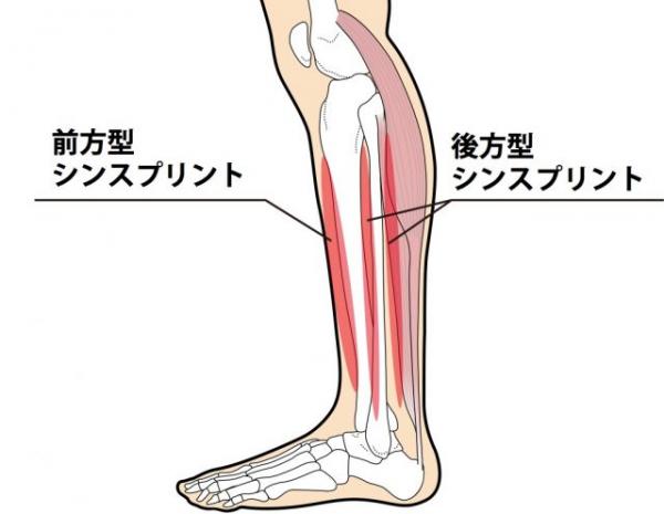 シンスプリント（脛骨過労性骨膜炎）について