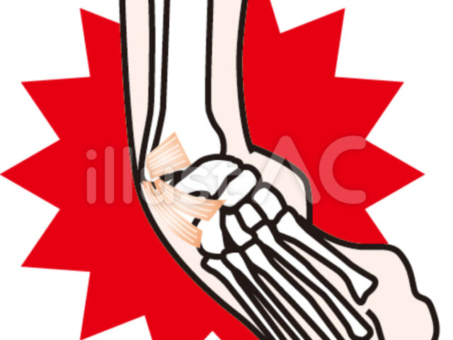 足首の捻挫甘く見ないでください！