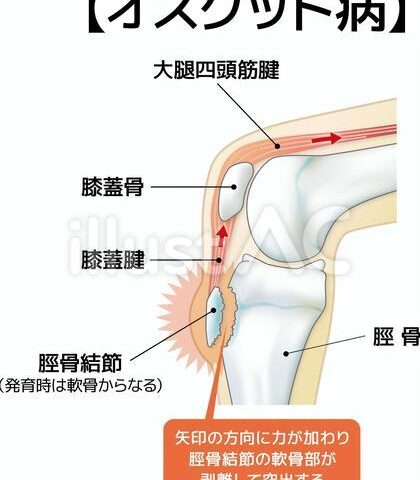 成長期の膝の痛み「オスグッド」とは？