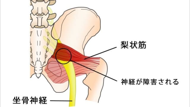 お尻から足にかけてのしびれ…それは坐骨神経痛かもしれません